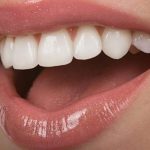 باورنکردنی‌ترین مزایای بلیچینگ دندان