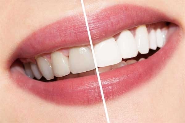 باورنکردنی‌ترین مزایای بلیچینگ دندان